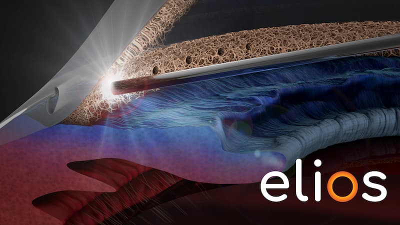 Excimer-Laser-Trabekuloplastik (ELT)